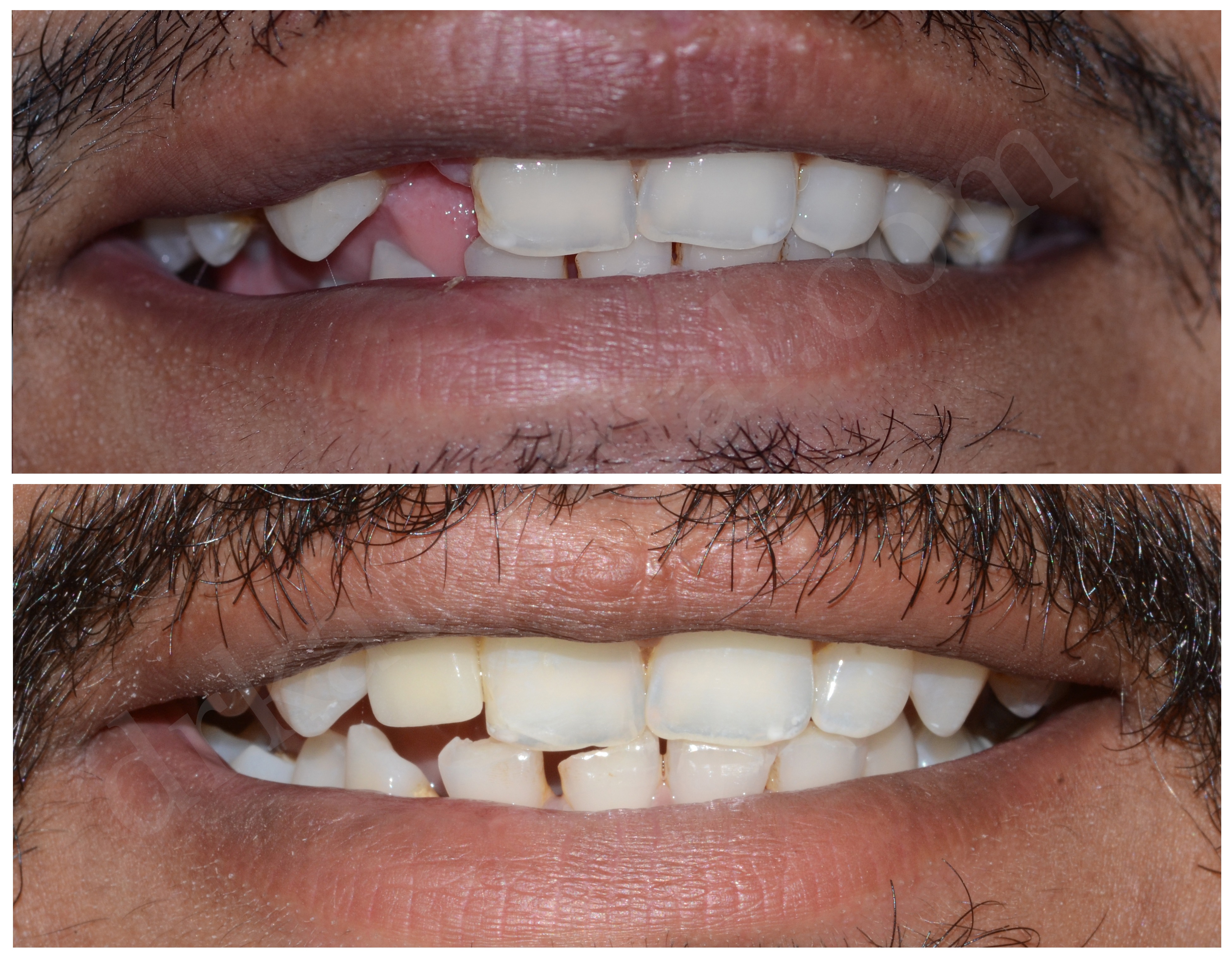 Transformation dentaire 3
